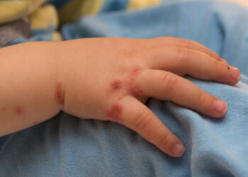 Hindistan’daki Domates Gribi Salgını Endişe Yaratıyor