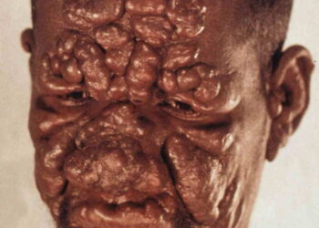 Cüzzam / leprosy: Sizden Farkındalık Bekliyor!