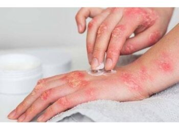 Uyuz Vakalarına Karşı Dikkatli Olunmalı!